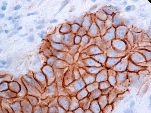 IHC of Beta-Catenin on an FFPE Breast Tissue